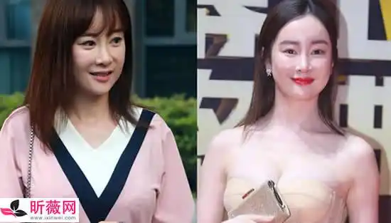 张檬最后悔的事情是整容张檬整容原因及前后对比照