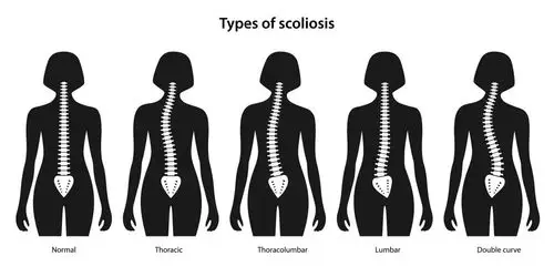 这个时候应拍摄站立位的全脊柱x线片,如果正位x线片显示脊柱有大于10