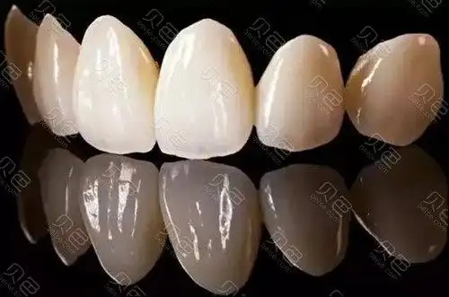 武汉全瓷牙冠费用标准分享科普全瓷牙和烤瓷牙哪个更好