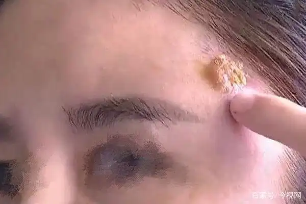 就在术后的半个月,她的脸上开始发炎流脓,全脸坍塌,如今她连镜子都不