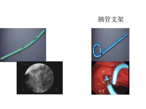 ercp下胆道胰管支架置入ppt