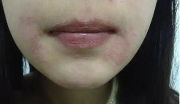 因为她们的银屑病发病部位在面部,这对女孩子的打击简直可以说是具有