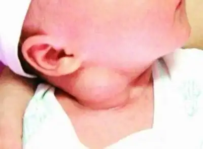 小儿先天性斜颈