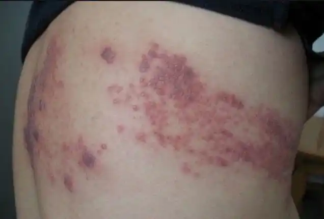 蛇盘疮缠腰龙带状疱疹绕腰一圈要人命