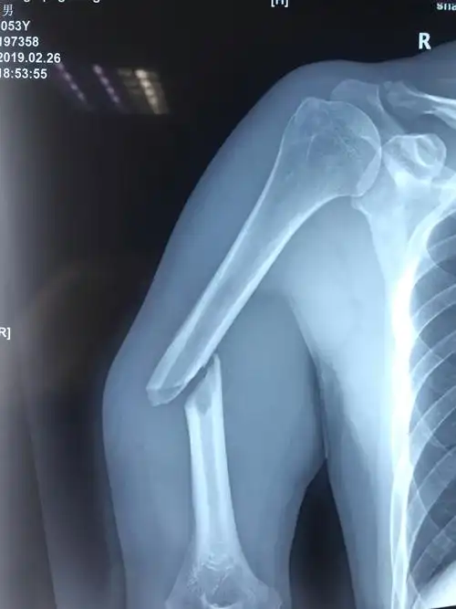 肱骨干简单骨折一期行双钢板内固定 植骨术