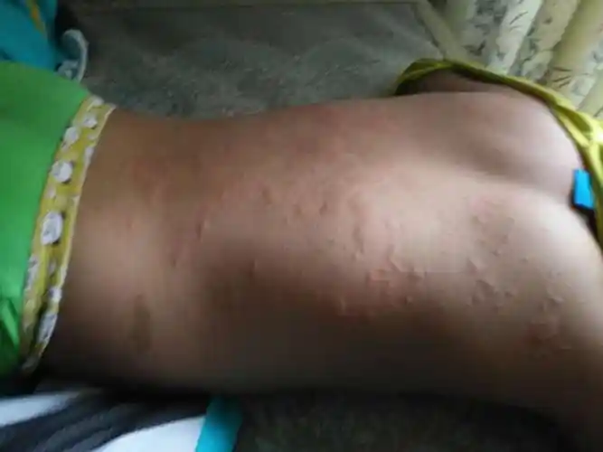 寻麻疹宝宝多久能好 寻麻疹宝宝多久能好不