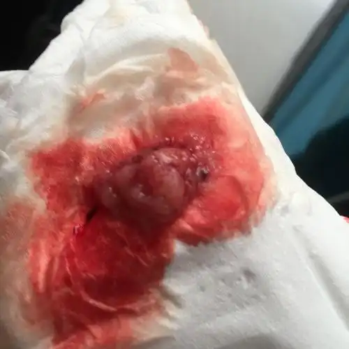 意外怀孕40天做的药流,吃完米索前列醇2个半小时排出的