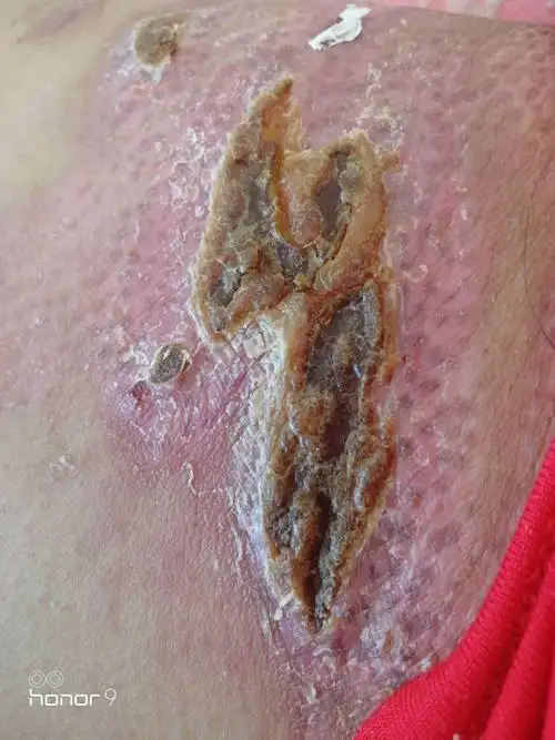 大腿根烫伤了结痂后不需要涂烫伤膏了吧