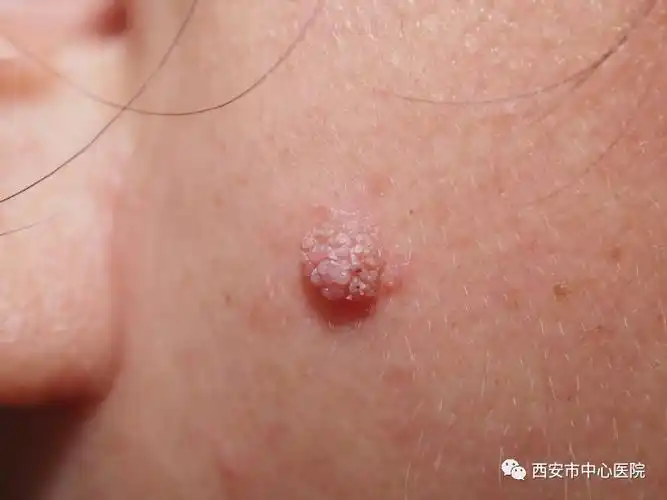 皮肤上的"小瘊子"越来越多该如何祛除呢?