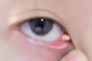 眼睛内角里面长一个白色物,不痛不痒,无不适感.有几年了.