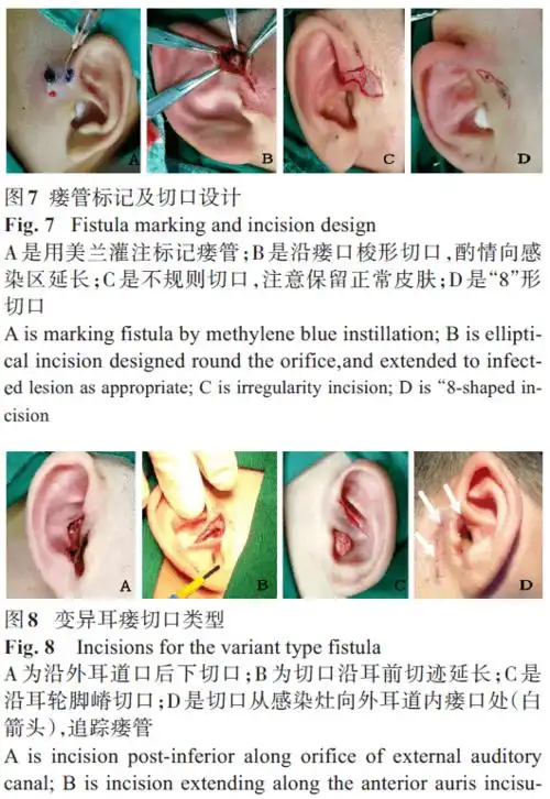 感染耳前瘘管的临床特征和手术治疗