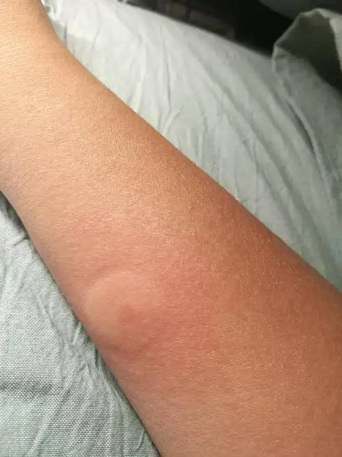 这种包是这个虫子咬的吗?这种是什么虫子