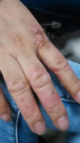 我朋友手上起皮脱落沾水后痒咨询一下什么病