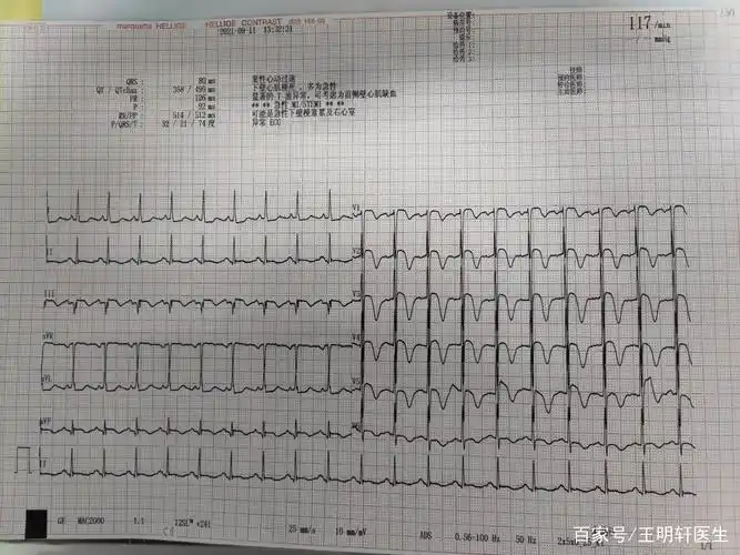 心电图胸前导联t波倒置