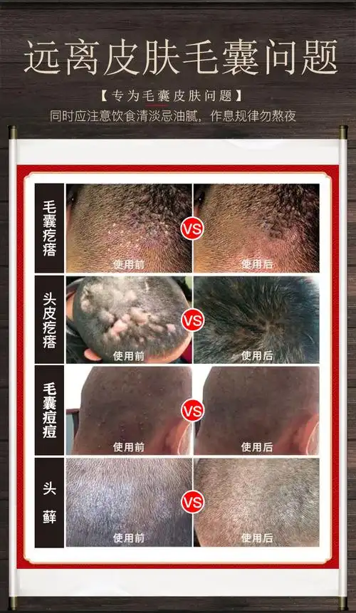 浅米草十方清毛囊头皮上长痘痘手臂脸部背部痒腿部膏 轻度(1盒装)