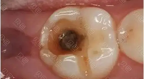 大牙烂了一半,里面都空了,怎么办?烂牙长期不补会怎么样?