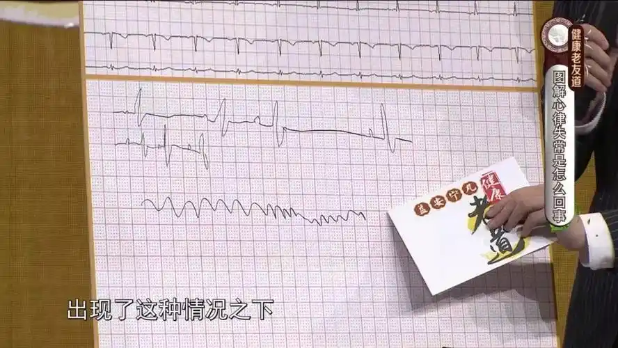 来看看心律不齐的自检方法!_心电图