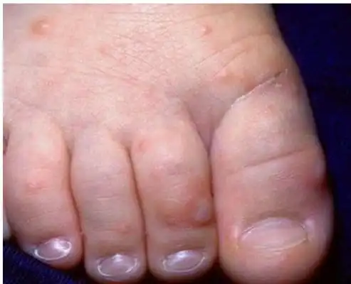 手足口病初期症状图片及治疗法 (58)