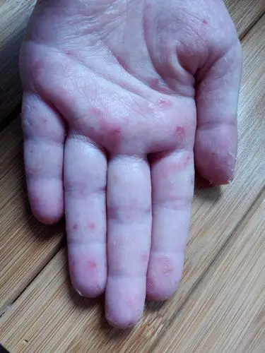 孩子6岁,从小就有汗疱疹的毛病,只是今年太严重了,一直用北京儿研所开