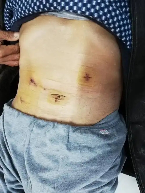 写美篇患者术中所见: 微创手术具有创伤小,恢复快,痛苦小,花钱少,疤痕