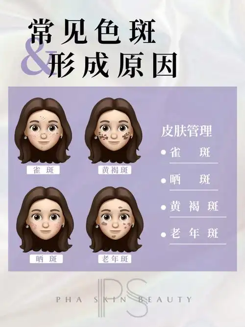 性质不稳定,随着外界因素影响而变化(如雀斑,黄褐斑,晒斑,铅汞斑)常见