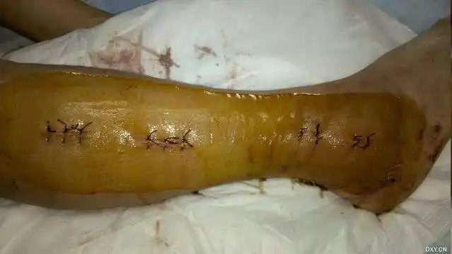 右小腿切口照片,现在切口已拆线了