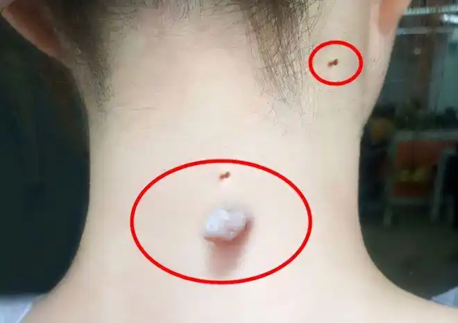 这种疙瘩与一般的疙瘩不一样,是凸起的,呈现菜花状的,这时候要警惕了