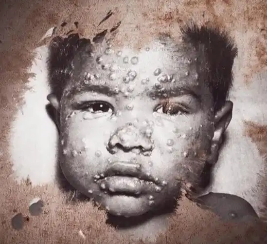 曾造成数亿人死亡的天花在中国怎样被消灭掉的