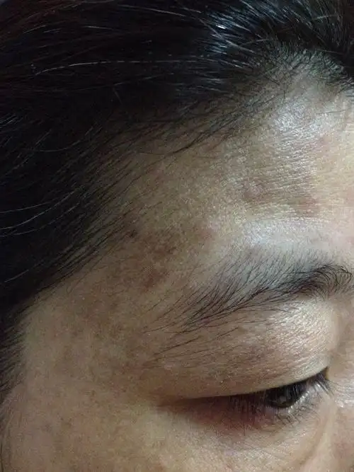 黑色素沉淀怎么办!