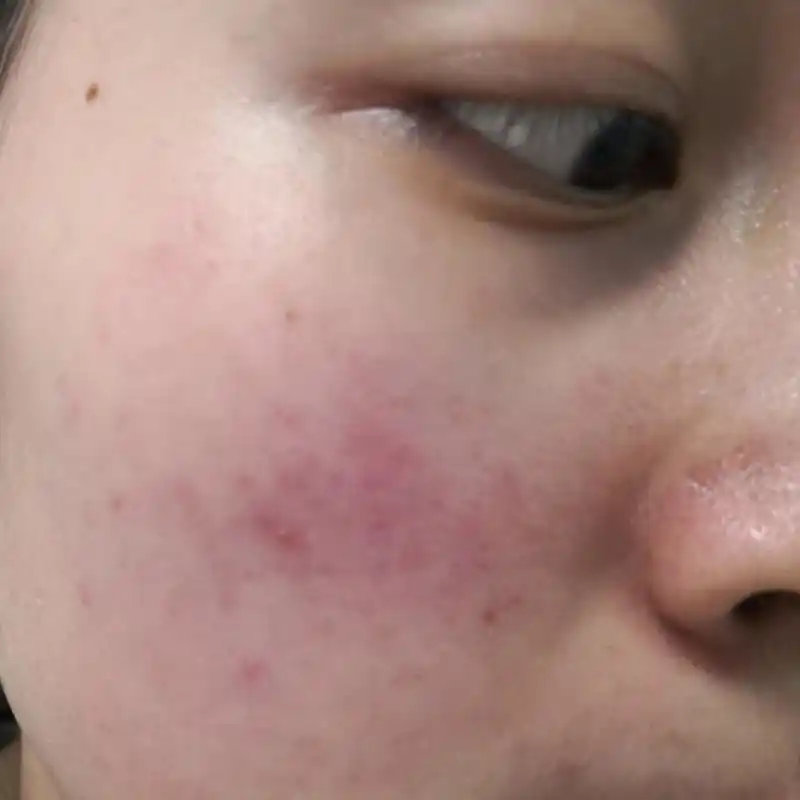 考虑玫瑰痤疮症状#玫瑰痤疮##酒渣鼻