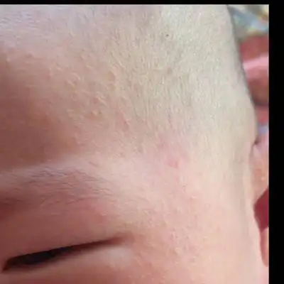 宝宝今天52天了 脸上有小痘痘 耳后也有 头皮里也