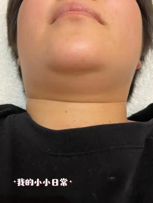 不会有什么明显的变化,但是到了病症的后期就会有很多淋巴结肿大加重