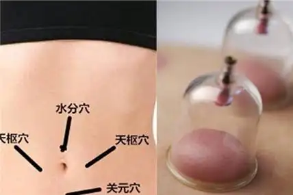 【图】拔罐减肚子拔哪里图解 这几个穴位准确达到减肥目的