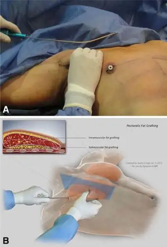 怎么摆脱男乳肥大,get大胸肌?这有一劳永逸的法子,等你来戳