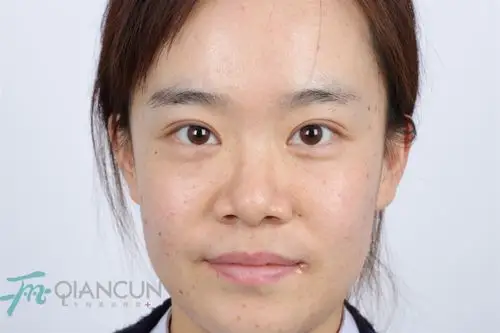 【真人案例】医院小护士亲自体验原生态肋骨鼻,美丽"变形记"_鼻子