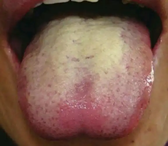 很多人都是不是明显可以看出他舌苔很是黄腻,这个就是说明体内有湿热