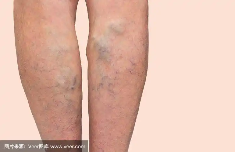 女性腿部静脉曲张