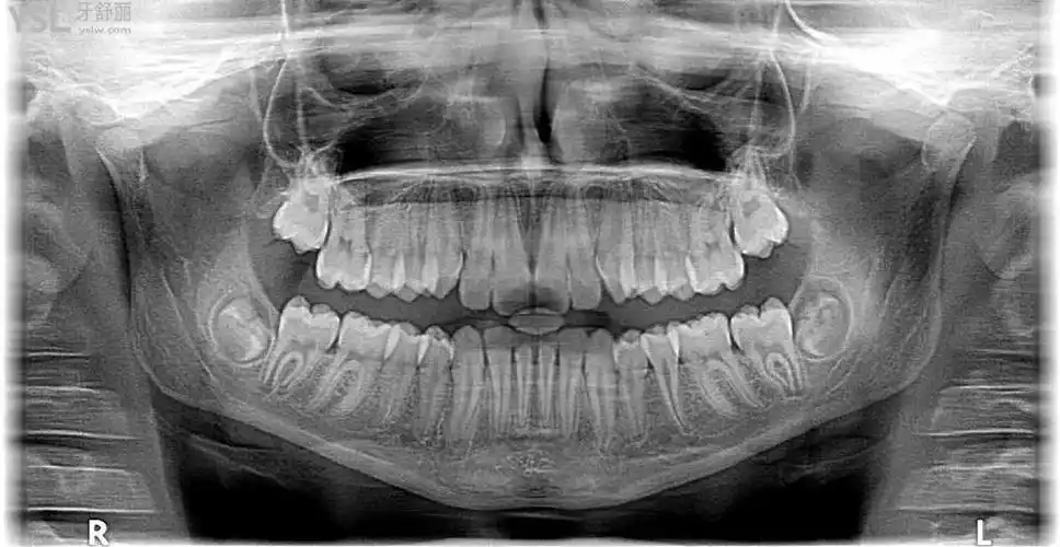 口腔ct片