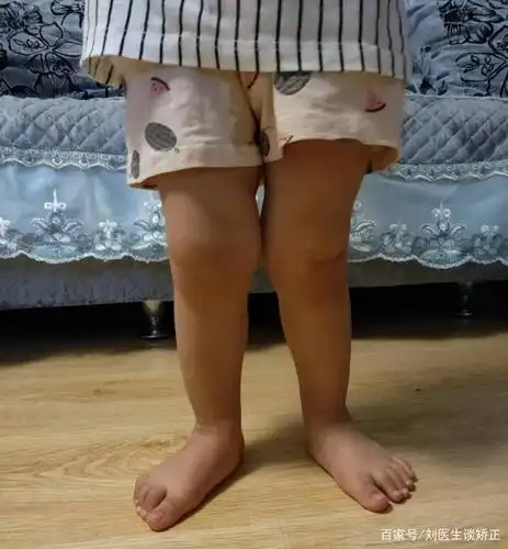 膝关节内侧膨大突出,形成一个鼓包