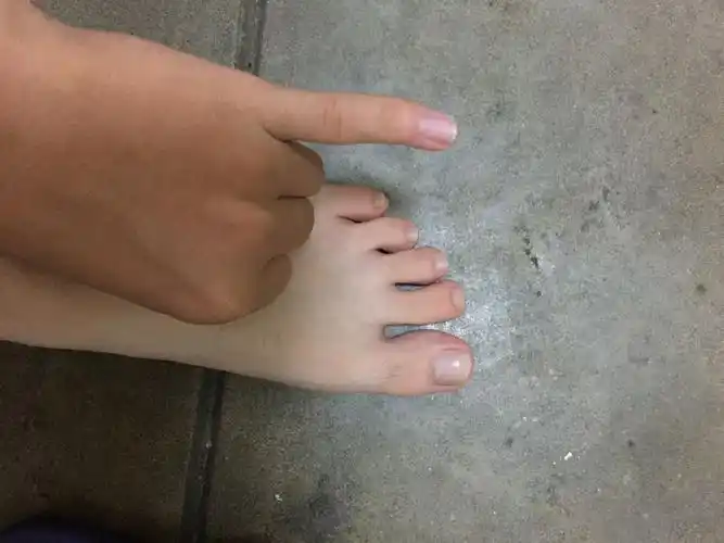 我的左右手小拇指和脚趾头变形怎么治疗