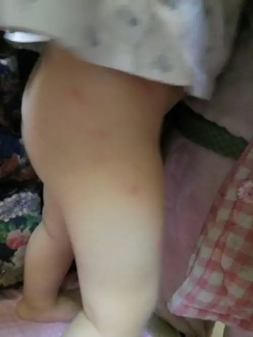 妈妈和宝宝身上都起了疙瘩,一开始宝宝脚面起,让诊所医生看了说是过敏