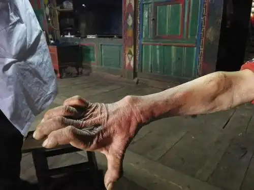 ▽这位牧民,因为尺神经损伤,导致了"爪形手".