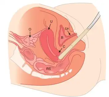 【友谊科普】妇科超声检查要注意什么?