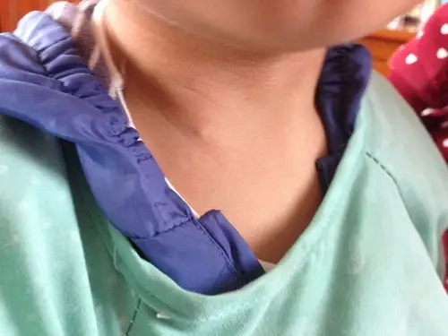 宝宝的脖子上长了一个小包,是怎么回事?