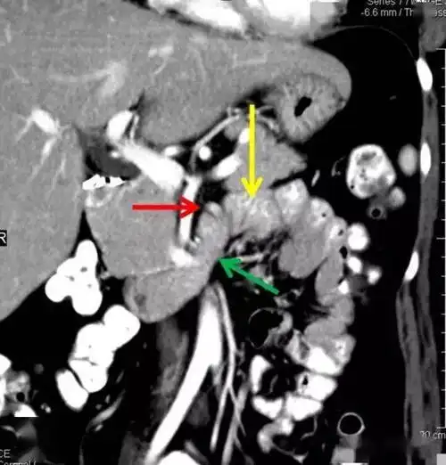 treitz韧带 | 怎么也看不见的屈氏韧带_解剖