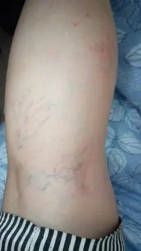 脚上有青筋,告诉我原因以及治疗办法,一定要详细啊.原因?治疗办法?