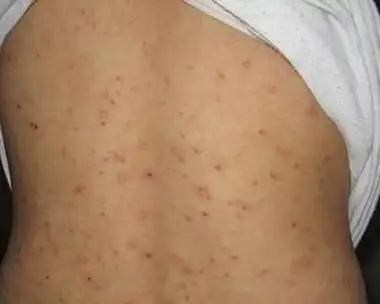 阴囊疥疮怎么治疗,疥疮的治疗方法(疥疮的发病机制,临床表现和治疗)