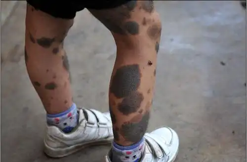 一女童浑身黑斑像兽皮 "熊猫娃娃"盼新生