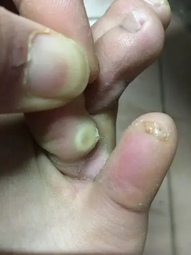 脚趾边长了个白的硬疙瘩,嗯起来很痛,长了一两天,请问这是不是鸡眼