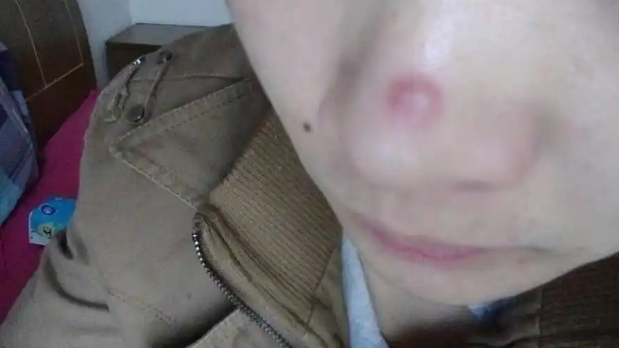 鼻子上长了一个红包,都有个多月了还没好.